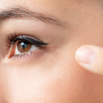 aesthetic treatments for crows feet